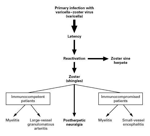 Neurologic Complications of the Reactivation of Varicella–Zoster Virus.