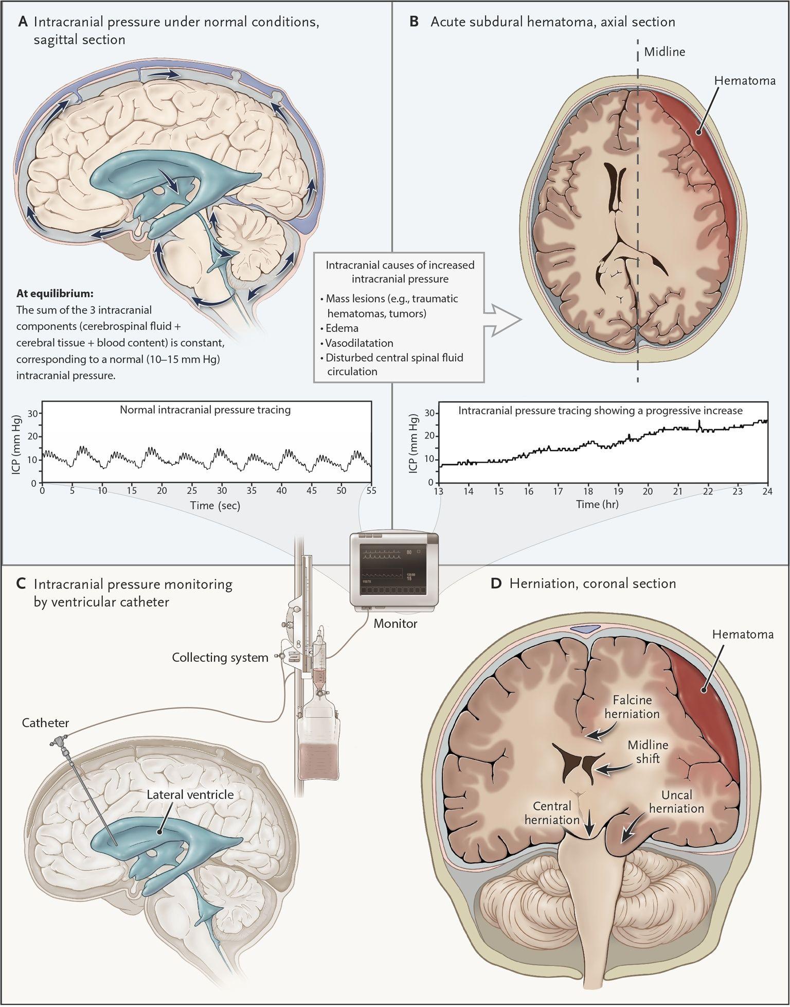 Intracranial Pressure under Normal and Abnormal Conditions.