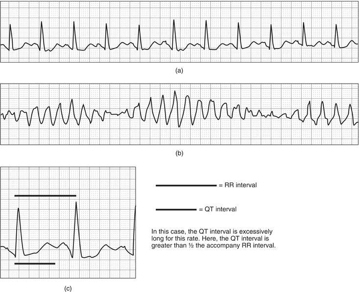 (a) Sinus tachycardia at 104 with prolonged QT interval. (b) Polymorphic VT (torsades de pointes) associated with QT interval prolongation. (c) Determination of the prolonged QT interval – if the QT interval is longer than half the accompanying RR interval, then that QT interval is prolonged.