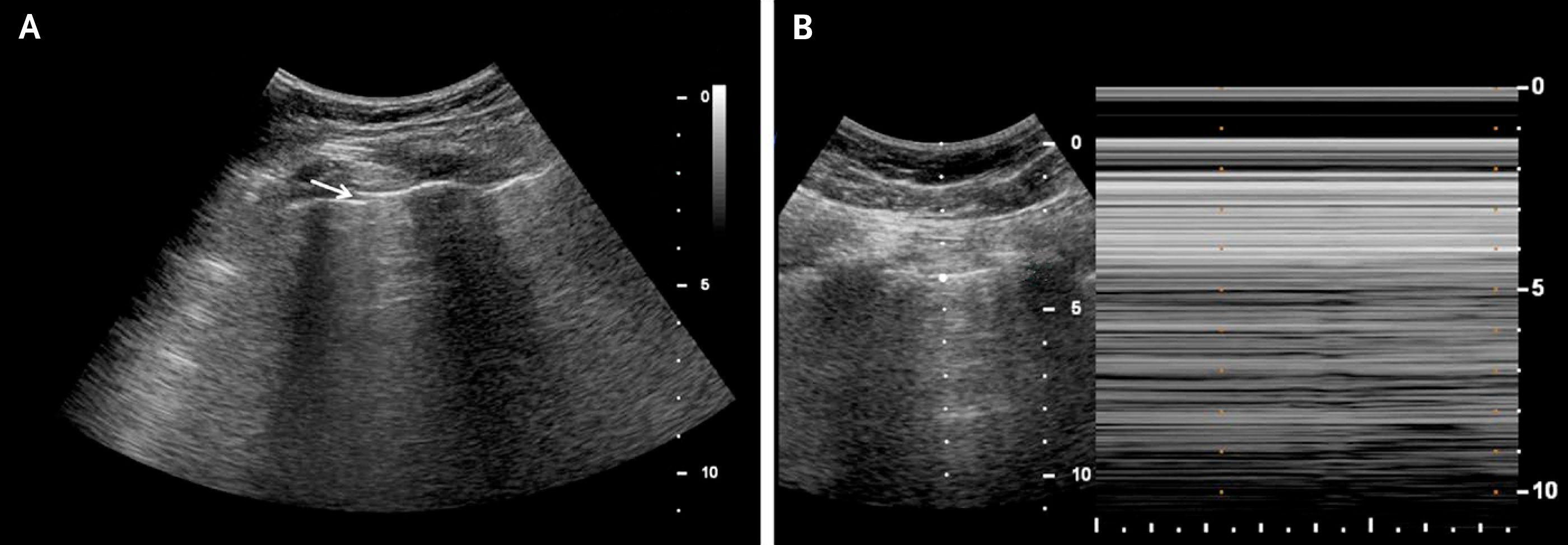 Ultrasound Images of the Lung with Features of Pneumothorax.