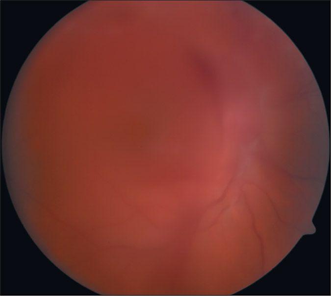 Figure 3. Fundus Photograph of Vitreous Hemorrhage