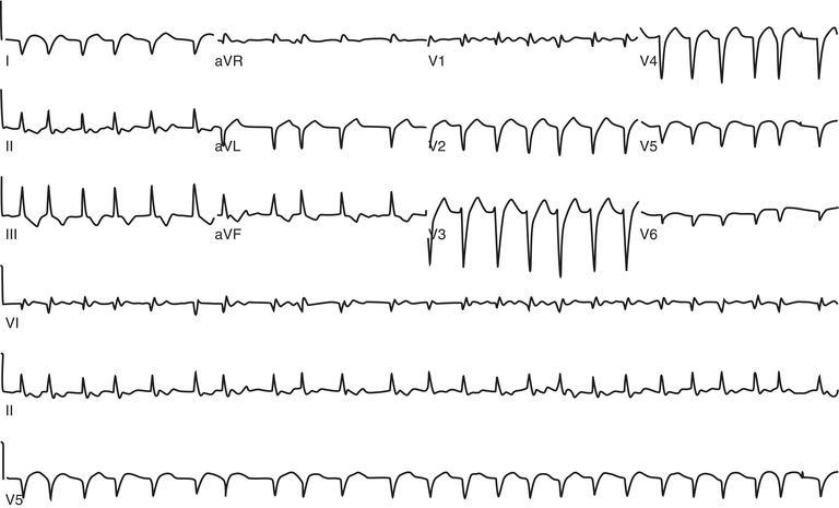 Atrial fibrillation with rapid ventricular response.