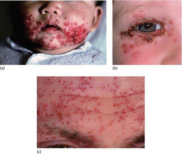 Eczema herpeticum: (a) perioral; (b) Periocular; (c) forehead. (Source: Part (c) courtesy of Addenbrooke’s Hospital, Cambridge, UK.)