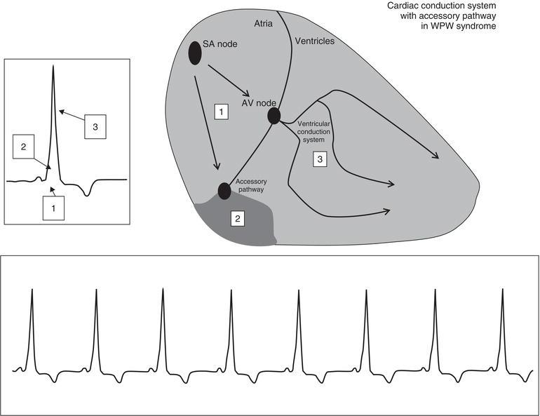 Figure 1. The ECG in the patient with WPW syndrome while in normal sinus rhythm ( NSR ). Note the classic triad of ECG findings, including the shortened PR interval (denoted by “1”), the delta wave (the initial slurring of the QRS complex, “2”), and the minimally widened QRS complex (“3”). While in NSR, the impulse travels through the atrial tissues and is transmitted to the ventricle via both the AV node and accessory pathway. The impulse arrives earlier than anticipated to the ventricular myocardium thus the PR interval is shorter (“1”) than the normal lower range of 0.12 seconds. The impulse travels into the ventricle via both the AV node and accessory pathway. The portion of the ventricular myocardium that depolarizes as a result of the impulse traveling through the accessory pathway is manifested on the ECG by the delta wave (“2”). Then, as the impulse moves into the ventricle via the accessory pathway and intraventricular conduction system, the QRS complex is minimally widened (“3”). This widening results from the inefficient conduction of the accessory pathway‐transmitted impulse throughout the ventricular myocardium (i.e. the intraventricular conduction system is not used).