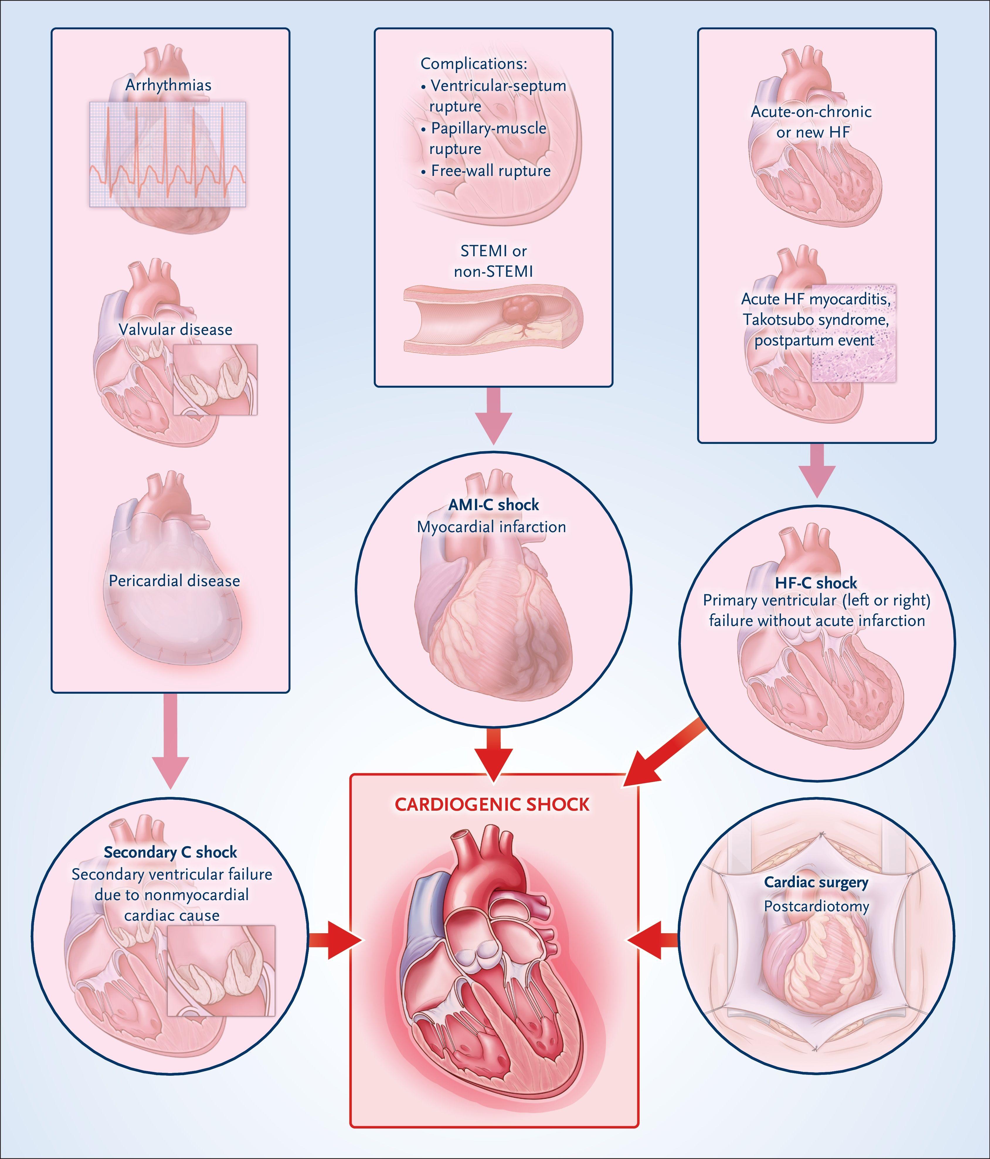 Causes of Cardiogenic Shock.