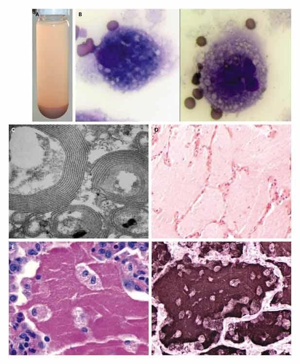 Appearance of the Lipoproteinaceous Material Accumulating in the Lungs in Acquired Pulmonary Alveolar Proteinosis.