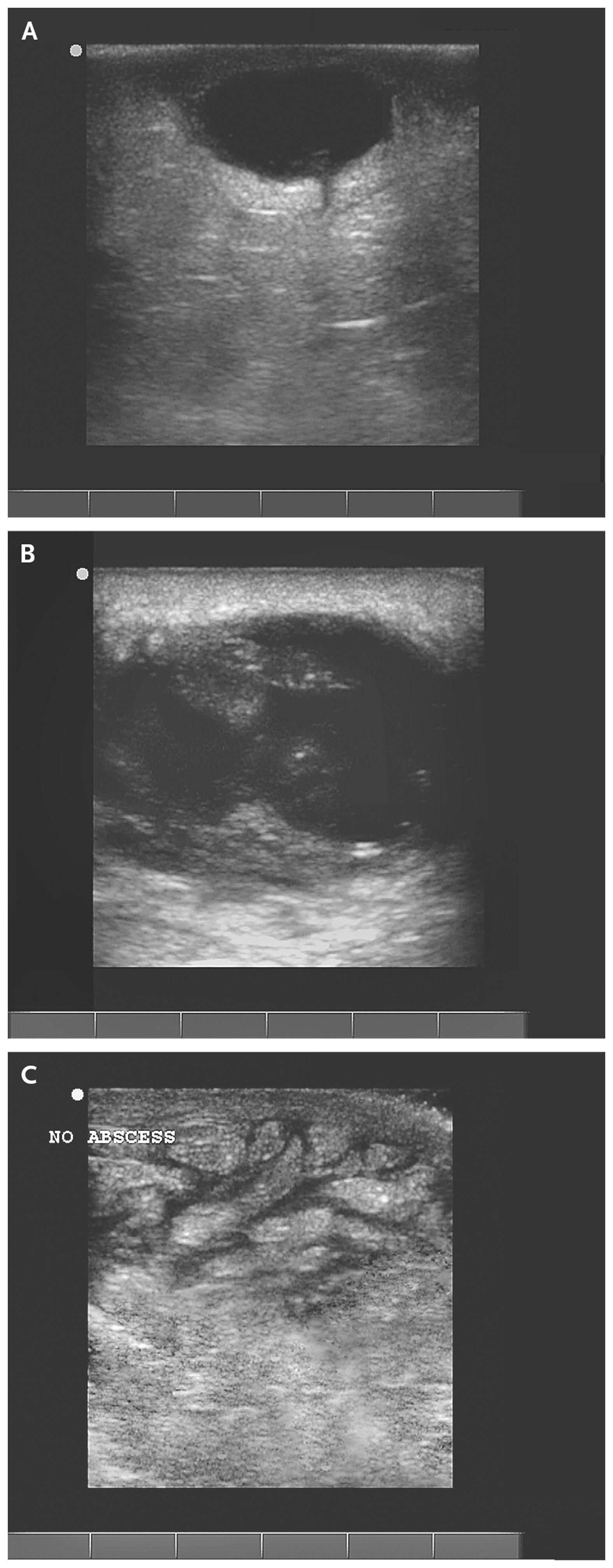 Ultrasonographic Images of Skin Abscesses.