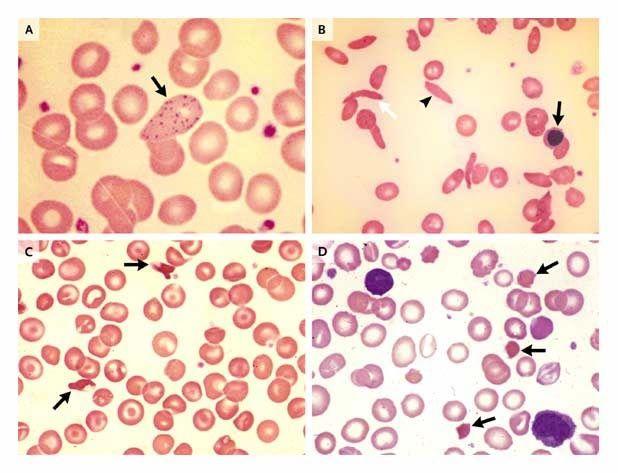 Red-Cell Changes with Lead Poisoning and in Hemoglobinopathies.