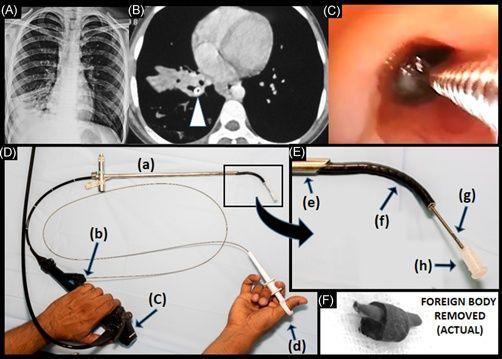 (A) Chest X‐ray: right lower lobe volume loss with cystic structures (some with air‐fluid levels).