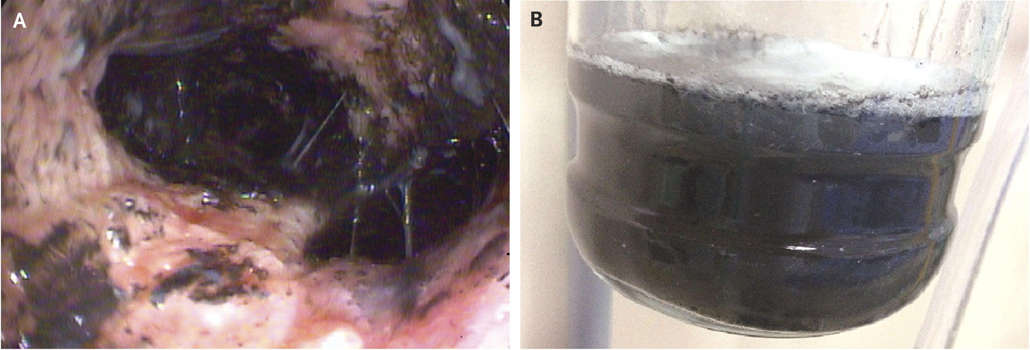High-Grade Airway Injury from Smoke and Sample of Bronchoalveolar-Lavage Fluid Recovered from Patients with Smoke-Inhalation Injury.