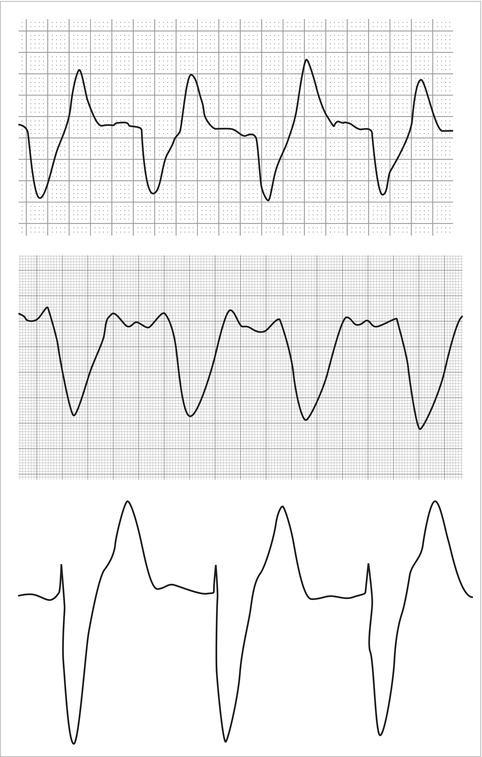 Widened QRS complex in severe hyperkalemia.