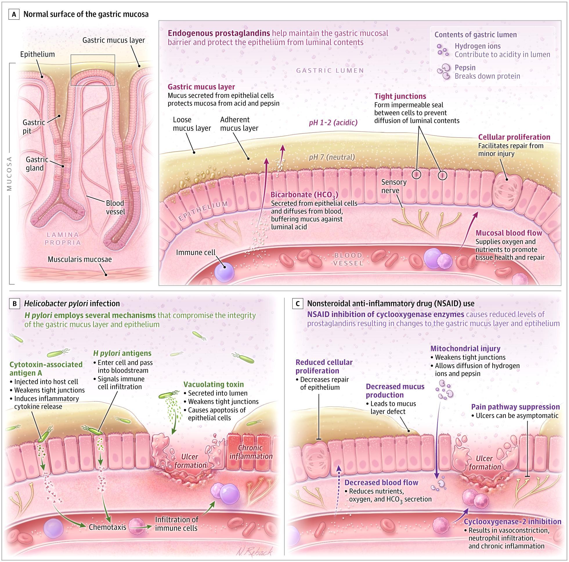 The Gastric Mucosal Barrier and the Pathogenesis of Peptic Ulcer Disease