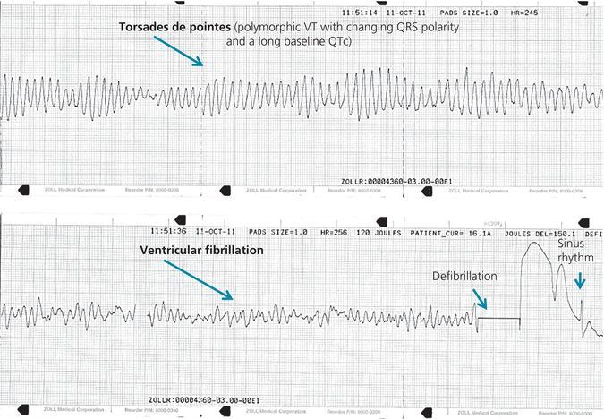 Torsades de pointes that degenerates into VF (same patient as Figure )