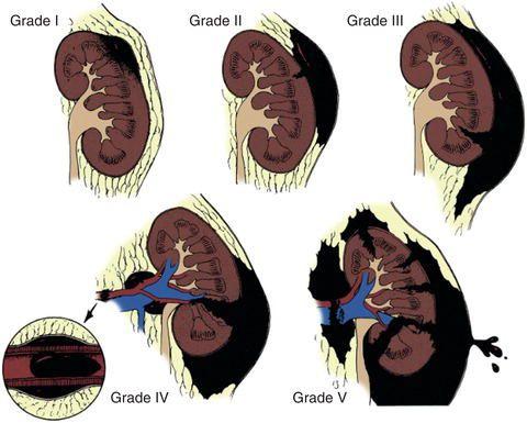 American Association for the Surgery of Trauma (AAST) Organ Injury Severity Score for the Kidney. Source: from Campbell‐Walsh, 10th Edition with permission .