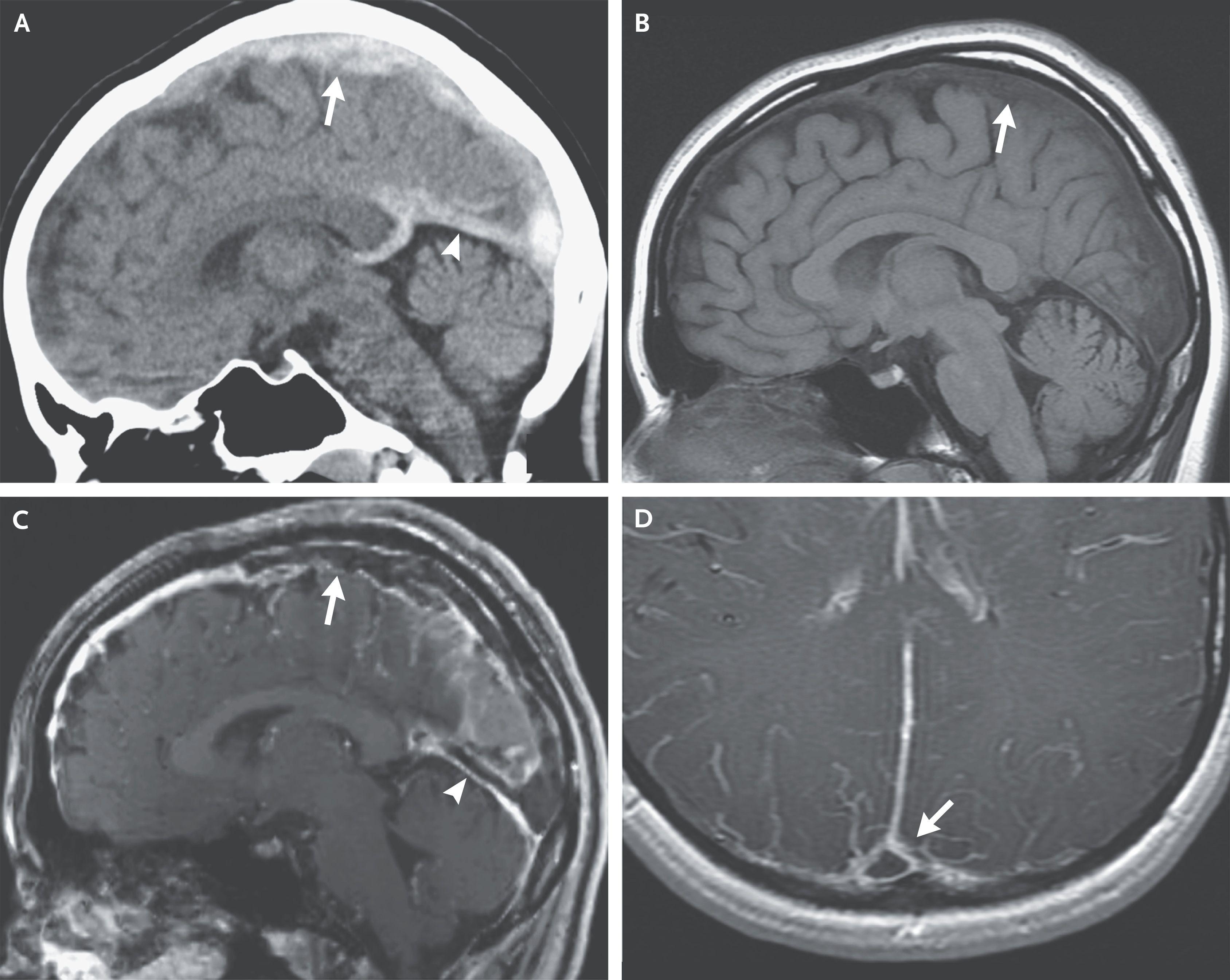 Imaging Studies of Venous Sinus Thrombosis.