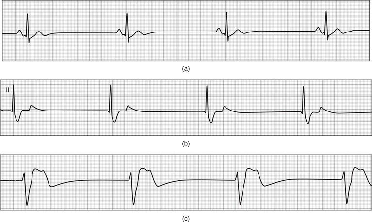 Bradycardias. (a) Sinus bradycardia – criteria for sinus rhythm are present with the exception of a rate less than 60 bpm. (b) Junctional bradycardia – a regular, narrow QRS complex rhythm without evidence of obvious P waves. (c) Idioventricular bradycardia – a regular, wide QRS complex rhythm without evidence of P waves.