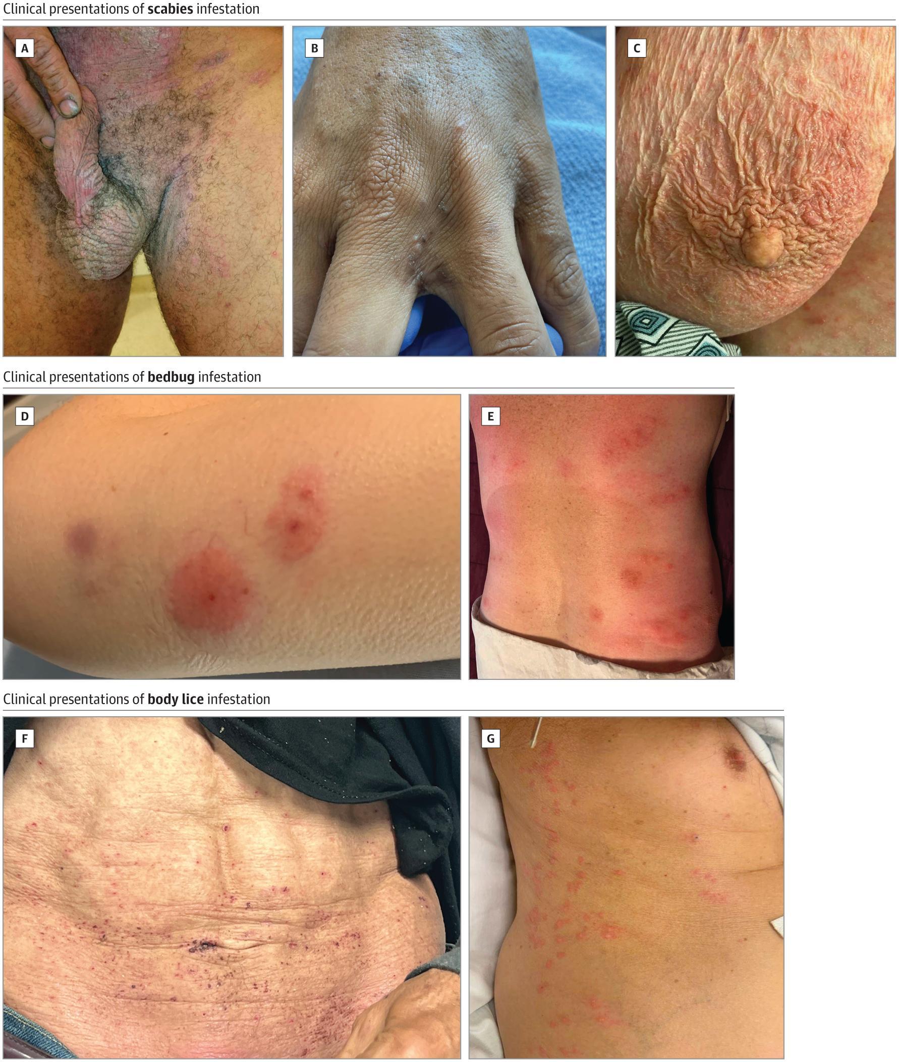 Clinical Presentations of Scabies, Bedbug, and Body Lice Infestations