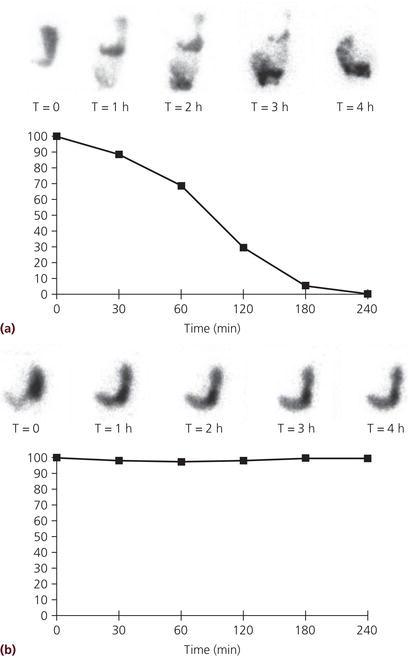 Gastric emptying scintigraphy using a technetium‐99m‐labeled egg sandwich meal which is ingested by the patient followed by imaging of the counts in the stomach over time. The percentages of gastric retention are shown for 0, 30, 60, 120, 180, and 240 min after meal ingestion. (a) Normal gastric emptying with only 30% retention at 2 h after meal ingestion (normal <60%) and complete emptying at 4 h (normal <10%). (b) Markedly delayed gastric emptying with little emptying at 4 h. Source: Courtesy of HP Parkman.