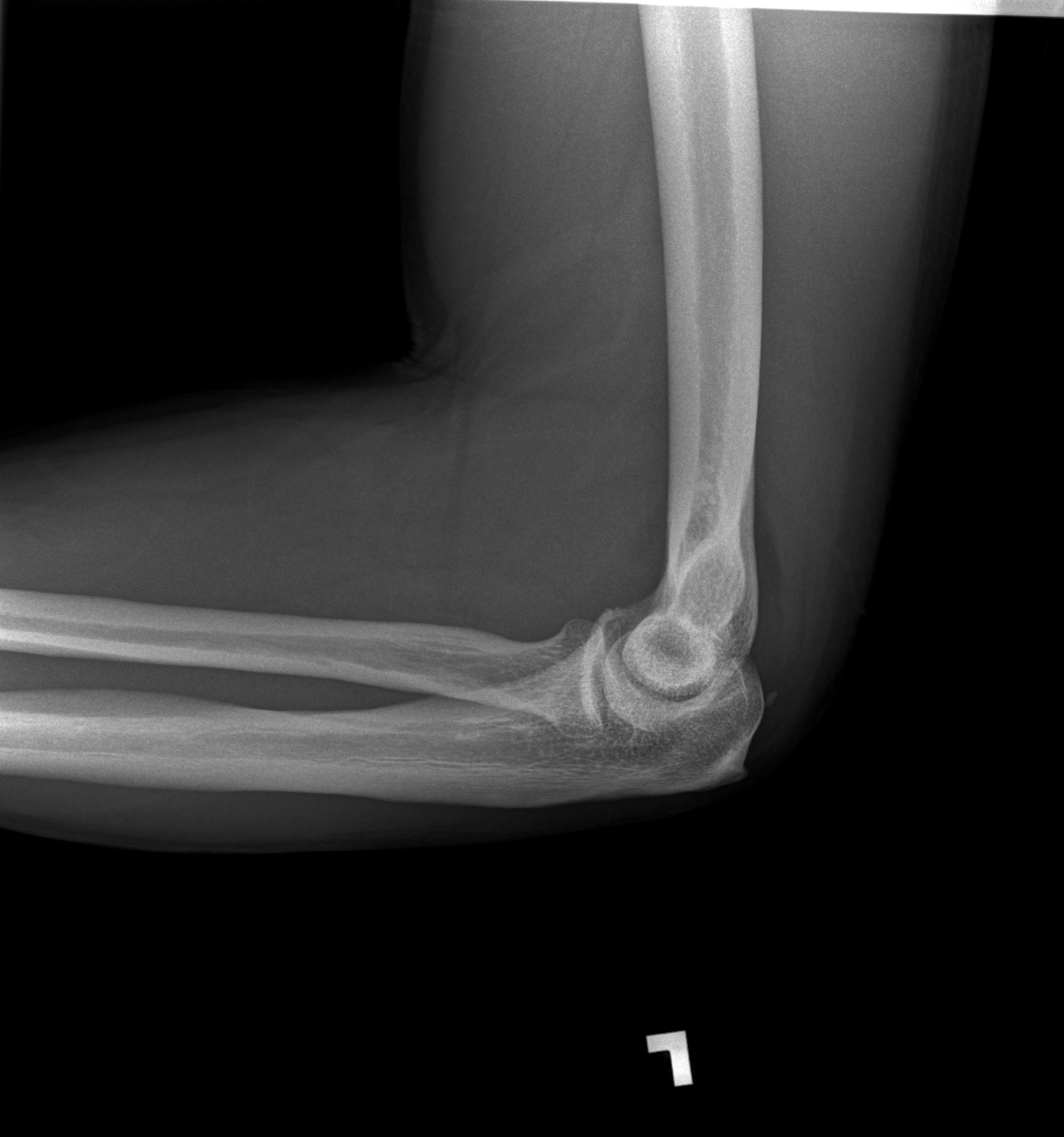 Elevation of anterior and posterior fat pads indicates left elbow joint effusion.