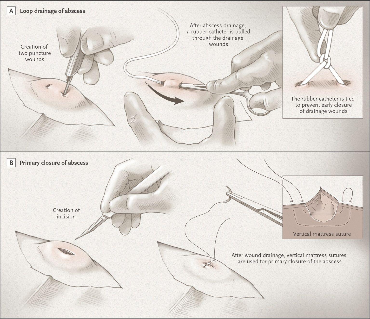 New Surgical Approaches to Abscess Treatment.