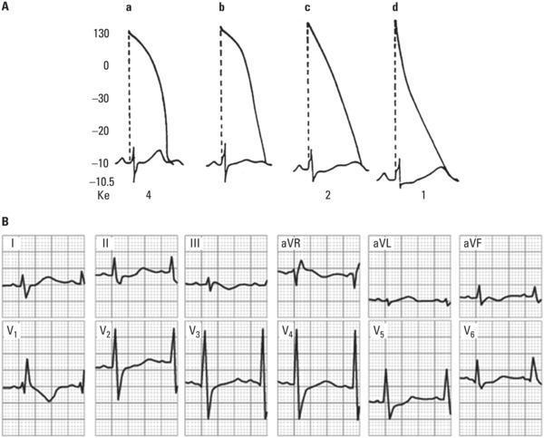 (A) Schematic representation of the ECG changes observed in the evolving stages of hypokalemia. The ventricular transmembrane action potential (TAP) has been drawn superimposed on the surface ECG. The diastolic transmembrane potential (DTP) value is to the left and the extracellular K + level is shown below. Note that as extracellular K + level progressively decreases, the ventricular TAP duration increases at the expense of the phase 3 velocity decrease. The U wave in the ECG tracing is gradually seen more clearly while the T wave tends to decrease, together with an apparent ST segment depression (adapted from Surawicz ). (B) This belongs to a 45‐year‐old patient with advanced mitroaortic heart valve disease treated with excessive doses of digitalis and diuretics. Extracellular K + level is 2.3 mEq/l. The ECG change corresponding to phase C of the scheme shown in Figure can be clearly seen, particularly in V2–V4.