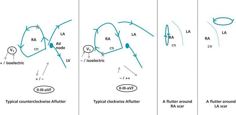 Flutter circuit with illustration of the net atrial vectors of depolarization ( gray arrows ) seen by the specific lead and the subsequent morphology of the flutter waves. The gray star indicates the starting point of the depolarization vector for illustration purposes. In typical counterclockwise flutter, the negative flutter wave is close to the QRS. Lead V 1 overlies the RA and mainly sees the local current in the RA, hence the positive deflection in V 1 , with possible return to isoelectric baseline between deflections.