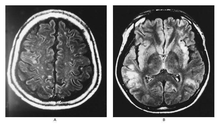 Axial MRI Findings in Patients with Acute (Panel A) and Relapsed (Panel B) Nipah Virus Encephalitis with Use of Fluid-Attenuated Inversion Recovery.