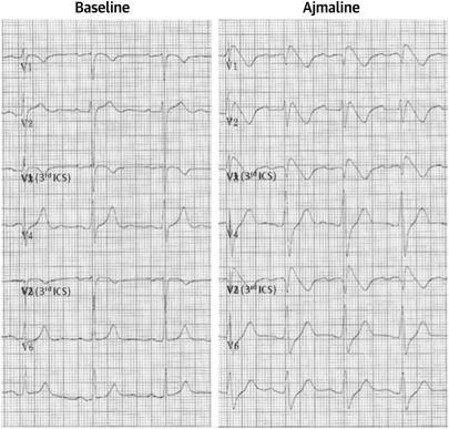 Electrocardiographic Pattern of Brugada Syndrome Induced By a Pharmacological Drug