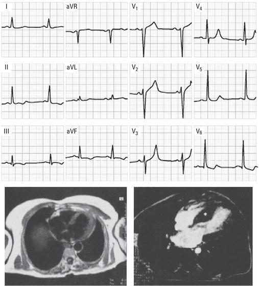 Top: ECG with left ventricular enlargement pattern not specific of any heart disease. Below: Cardiovascular magnetic resonance (CMR) (right) showing an asymmetric septal hypertrophy (asterisk), which confirms the diagnosis (HCM). Left: CMR with normal left ventricle image (for comparative purposes). It should be pointed out that echocardiography allows us to reach the same diagnosis.
