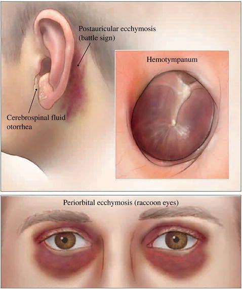 Findings suggestive of basilar skull fractures are Battle sign, hemotympanum, cerebrospinal fluid otorrhea, or raccoon eyes.