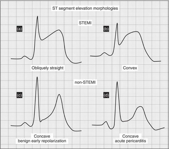 ST segment elevation subtypes in STEMI and non‐STEMI presentations. (a) STEMI with obliquely straight ST segment elevation; (b) STEMI with convex ST segment elevation; (c) non‐STEMI ( benign early repolarization , BER ) with concave ST segment elevation; (d) non‐STEMI (acute pericarditis) with concave ST segment elevation.