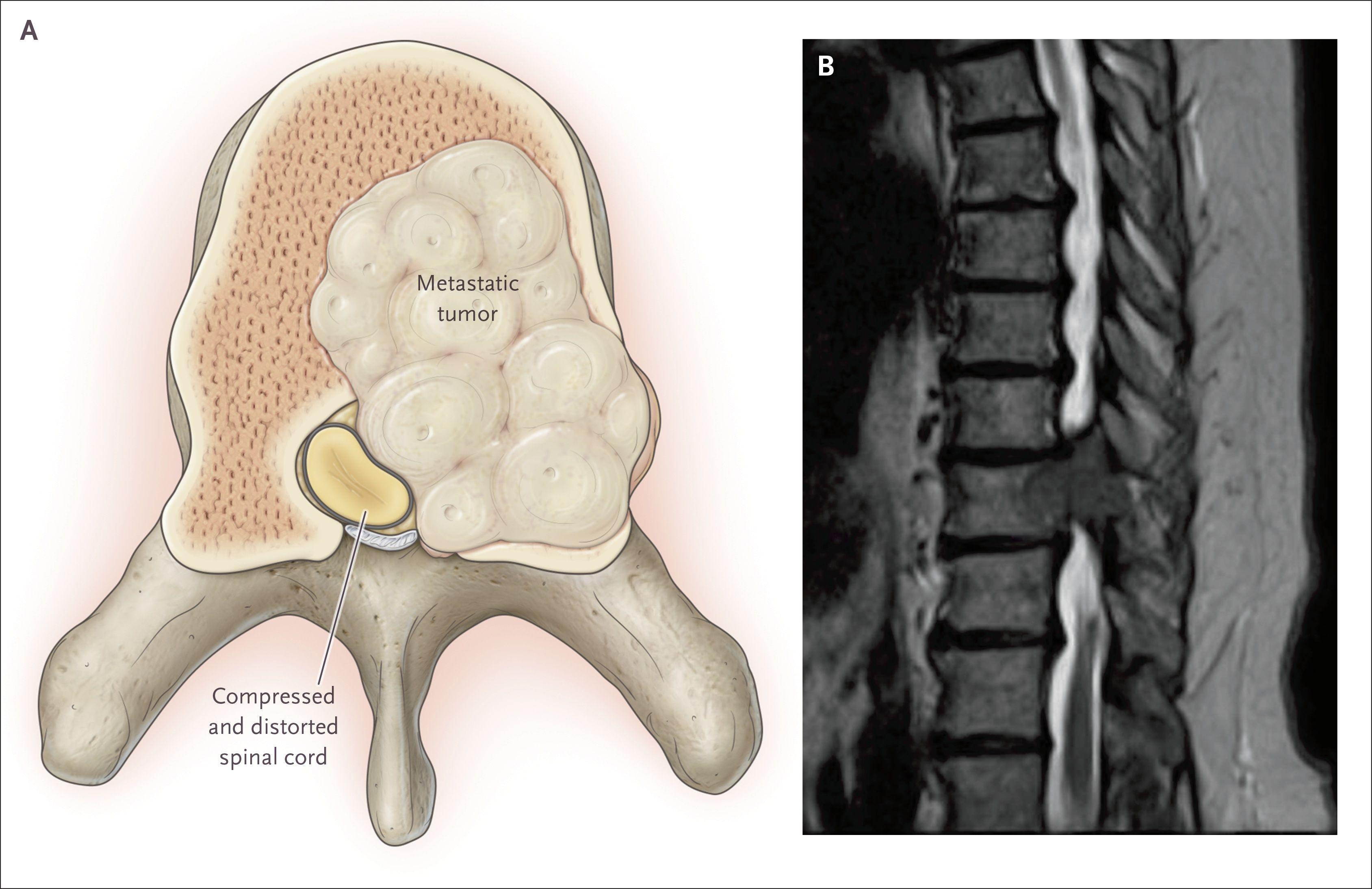 Acute Cord Compression Due to Metastatic Cancer to a Vertebral Body.