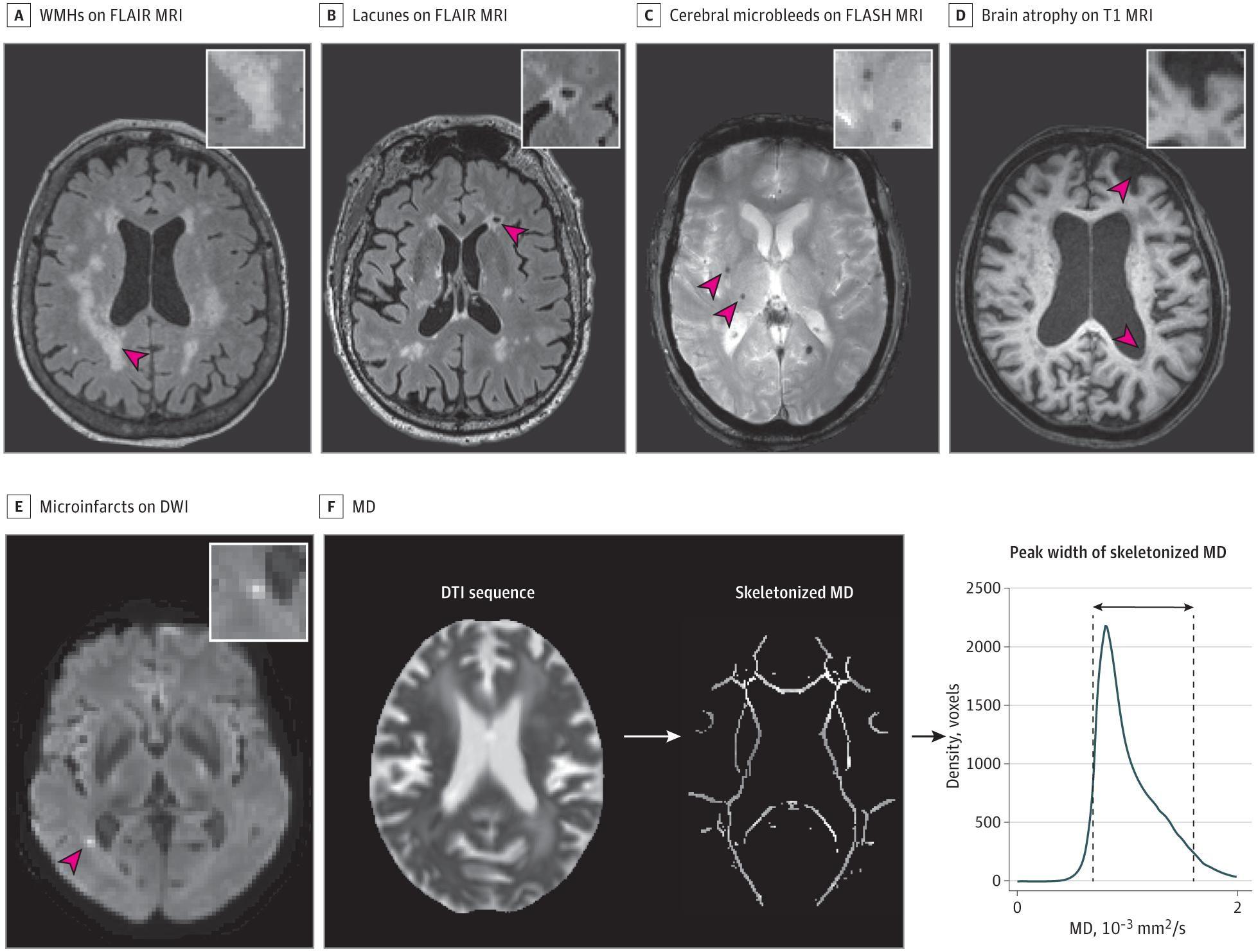 Different Radiological Features of Small Vessel Disease Visible on Magnetic Resonance Imaging (MRI)