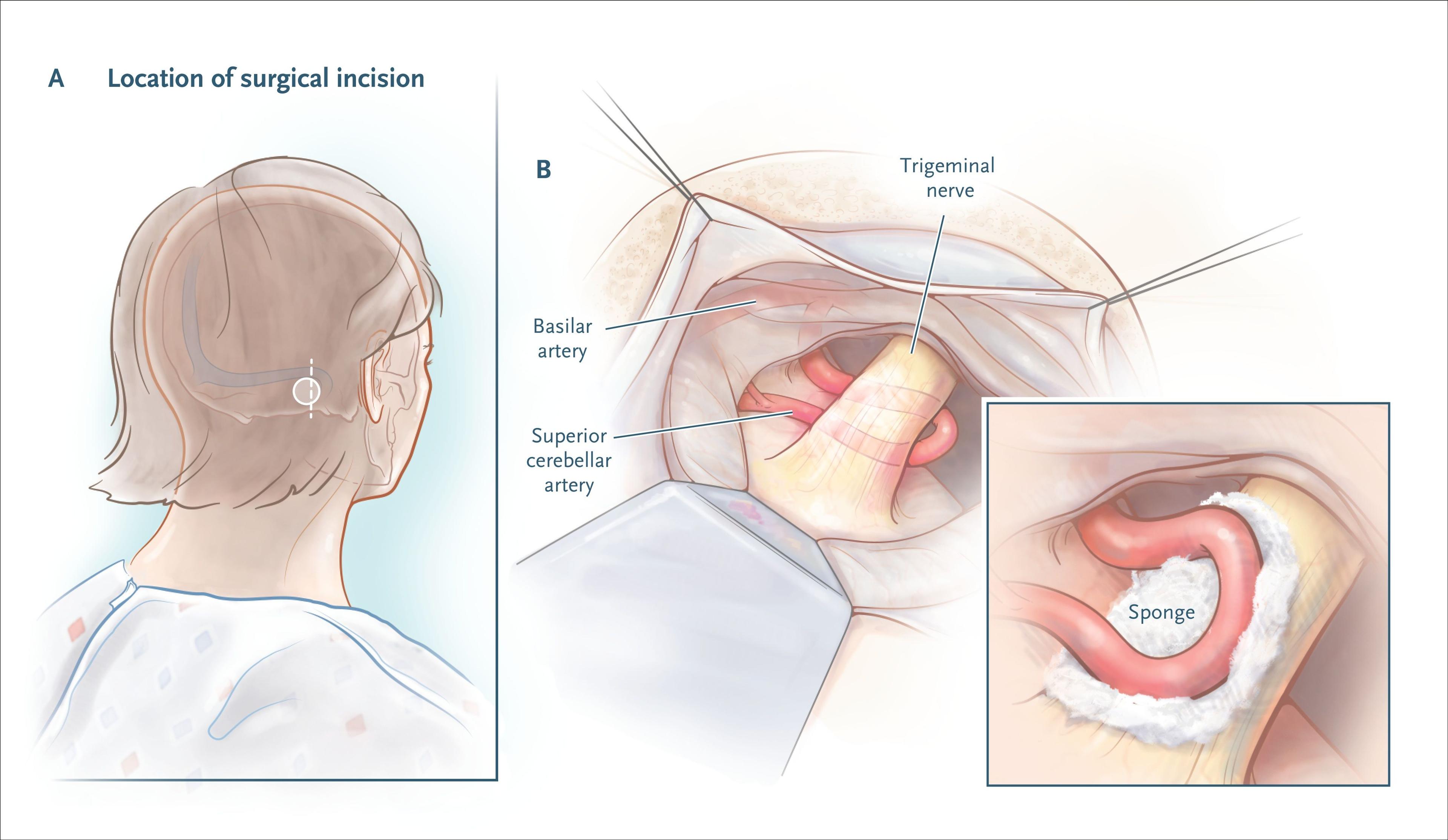 Microvascular Decompression.