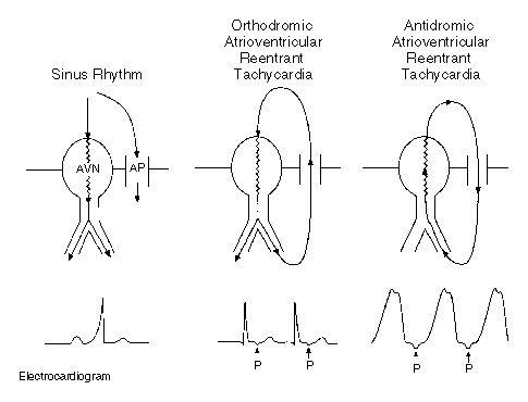 Figure 2. Mechanism of Atrioventricular Reentrant Tachycardia in Patients with the Wolff–Parkinson–White Syndrome.