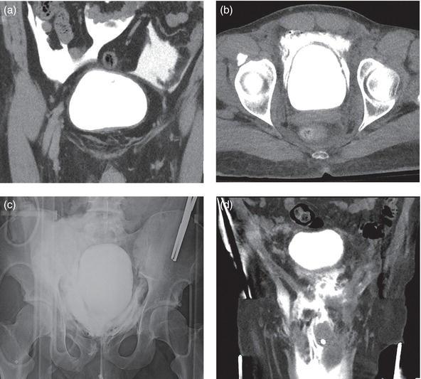 CT and fluoroscopic imaging of bladder rupture including: (a) coronal view of CT cystogram showing an intraperitoneal (IP) rupture with extravasated contrast outlining loops of bowel; (b) axial view of CT cystogram showing an EP bladder rupture with molar tooth extravasation pattern; (c) fluoroscopic cystogram showing an EP rupture with extravasation into the soft tissues of the pelvis; and (d): coronal view of CT cystogram showing an EP rupture with extensive extravasation tracking into the scrotum.