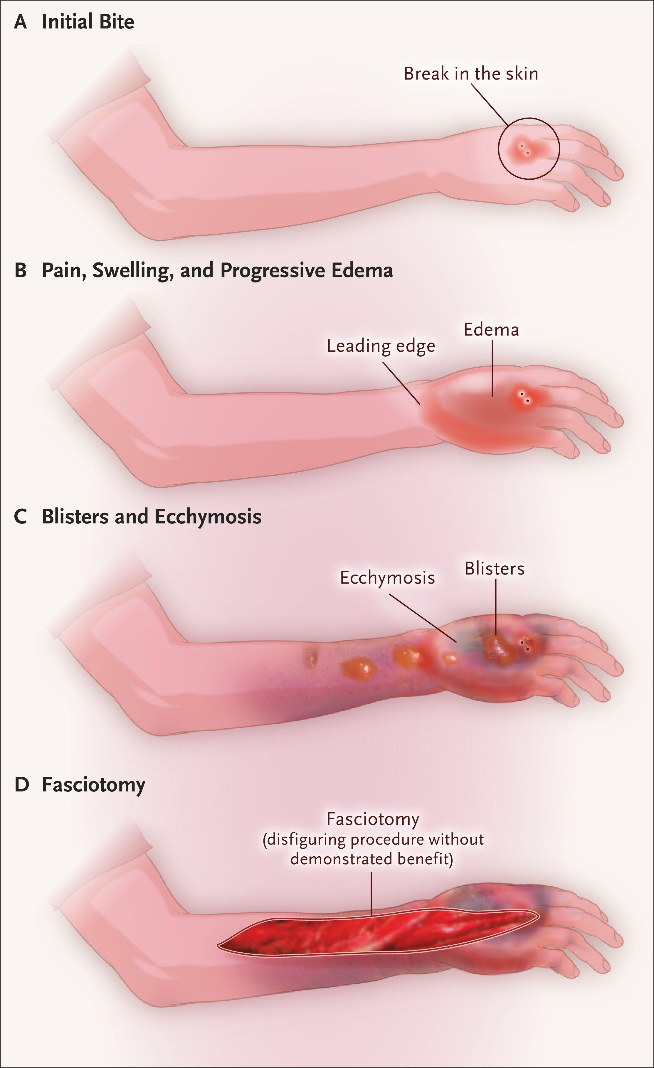 Clinical Appearance, Assessment, and Management of Snakebites.