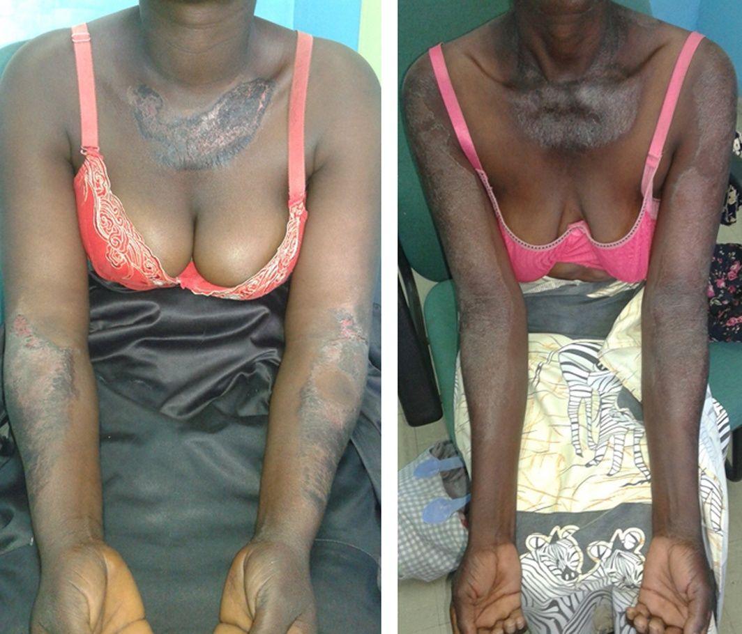 Two people (both from Malawi: the left patient in her 20s and the other in her 30s) with pellagra.