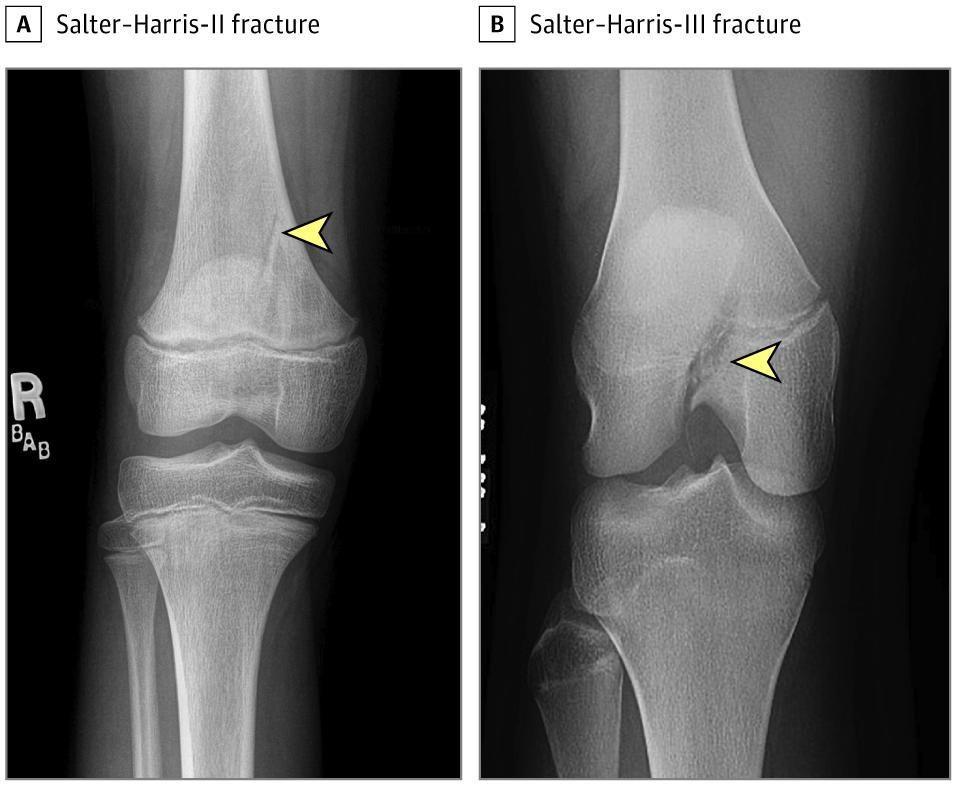 Salter-Harris (SH) Fracture Classification in the Distal Femur