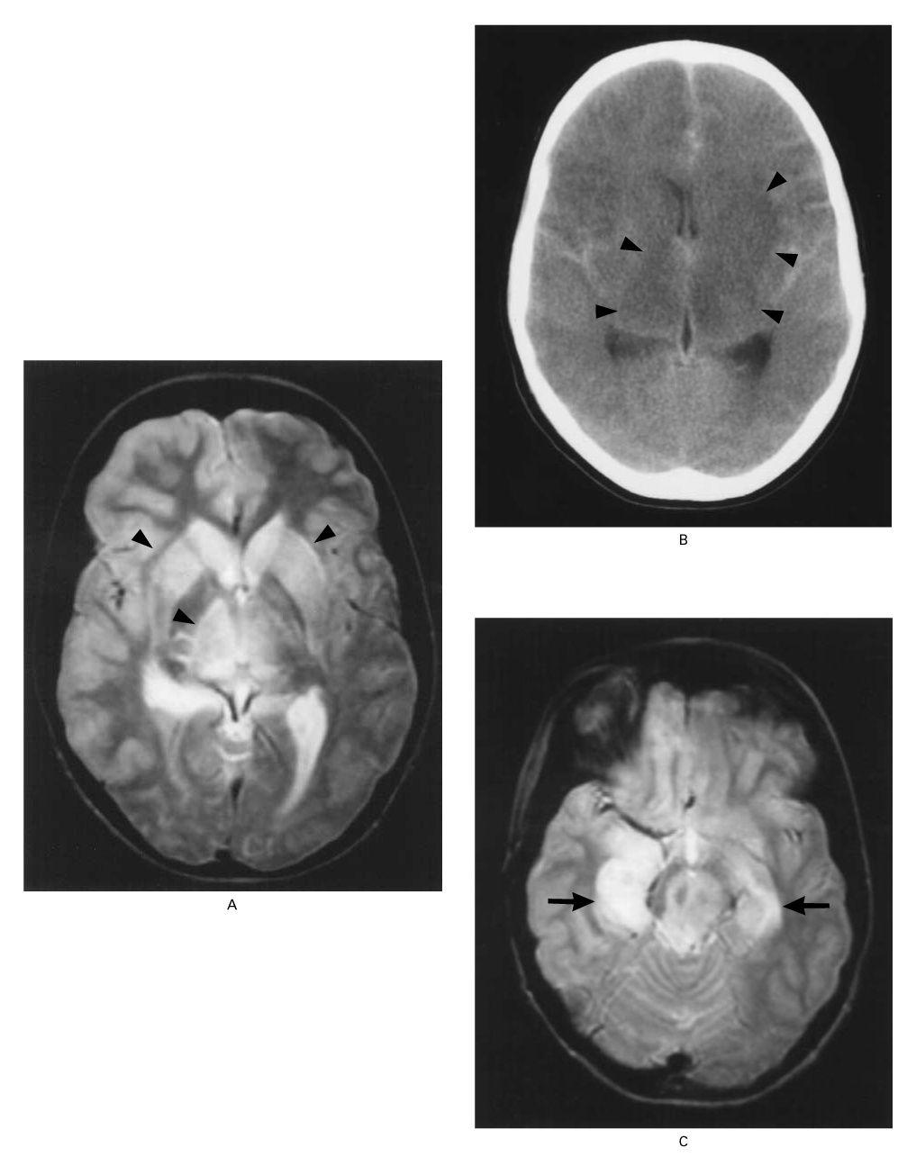 Lesions of the Basal Ganglia and Cortex in a 14-Year-Old Boy Who Died of Eastern Equine Encephalitis.