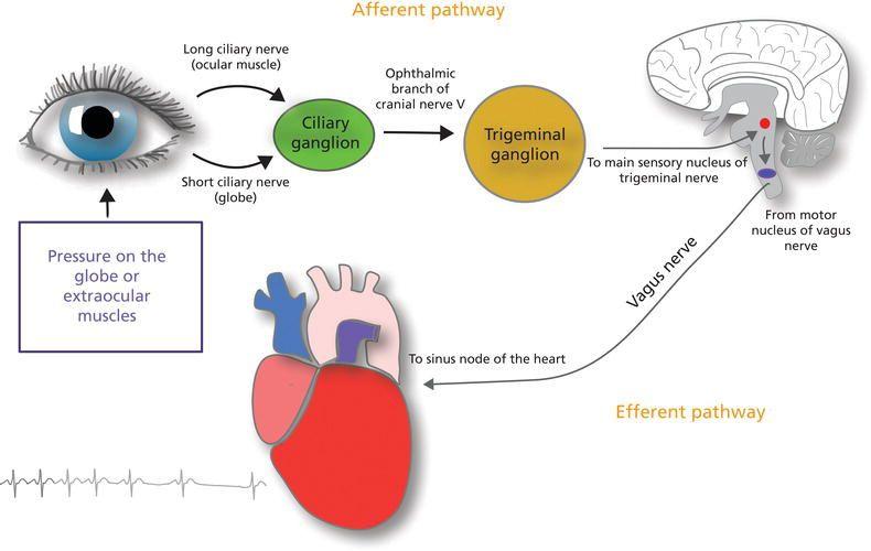 Oculocardiac reflex pathway. Source : Diagram by Mark Mazziotti MD.