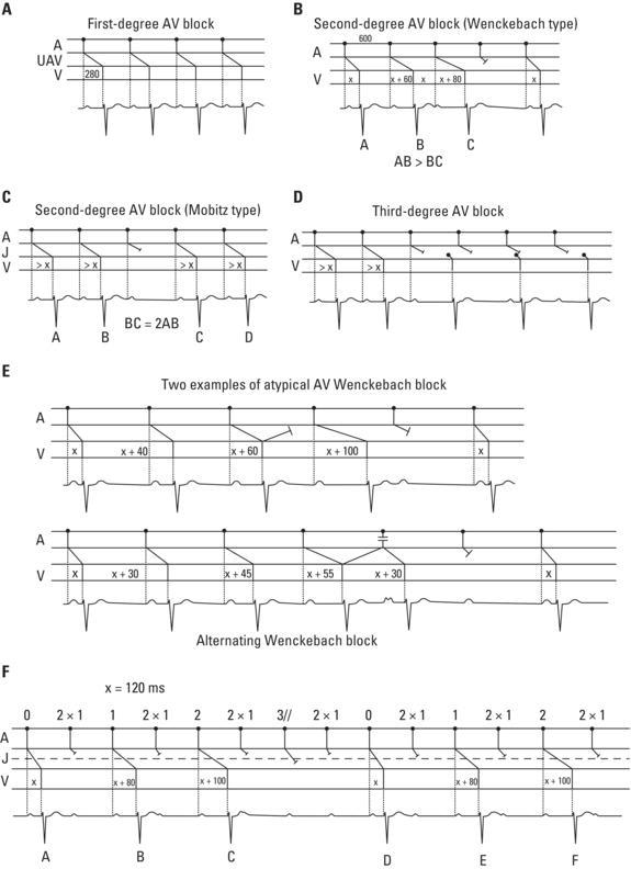 (A) First‐degree AV block. The PR interval is always prolonged (>200 ms); (B) second‐degree AV block 4 × 3 (Wenckebach type). The criterion AB > BC also applies in this case (see text and Figure B); (C) second‐degree AV block (Mobitz type) (BC = 2AB); (D) third‐degree AV block. A clear AV dissociation may be seen. After two QRS complexes have been conducted, there is a pause, followed by QRS (at slow frequencies) dissociated from P waves. In this case, the QRS complexes are junctional; (E) atypical Wenckebach blocks. Top: With abnormal lengthening of the increase preceding the pause (PR = x + 100) due to a concealed retrograde conduction of the preceding complex in the AV junction. Bottom: The abnormal PR shortening is due to the existence of a reciprocal complex in the AV junction; (F) example of an alternating Wenckebach block (see text).