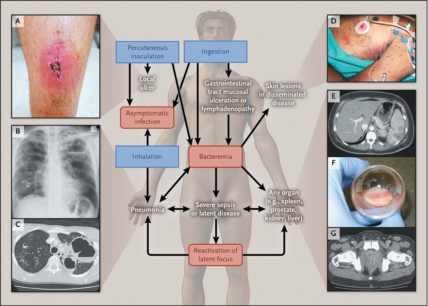 Clinical Events after Infection with B. pseudomallei.
