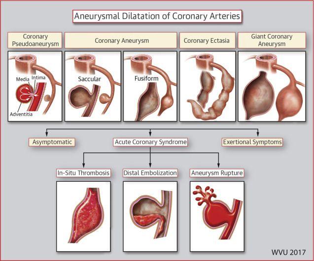 Illustration of the Variable Morphologies and Clinical Presentation of Aneurysmal Dilatation Involving Coronary Arteries