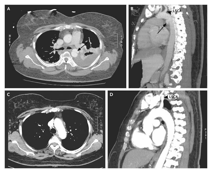 Aortic Injury with Associated Pseudoaneurysm.