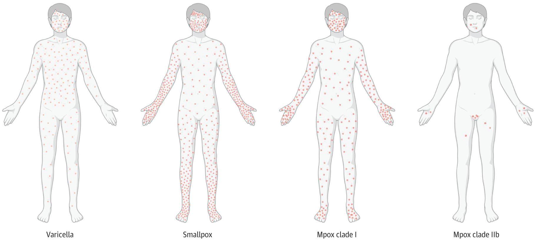 Distribution of Skin Lesions in Primary Varicella, Smallpox, and Mpox Clade I and Clade IIb