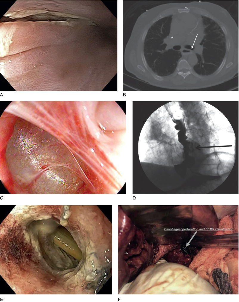Images of esophageal perforation. (A, B) Endoscopic and radiographic images of spontaneous esophageal perforation; (C, D) endoscopic and radiographic images of iatrogenic esophageal perforation; (E, F) endoscopic and intraoperative images demonstrating full‐thickness perforation. Sources: (A, B) Reproduced with permission from Chen and Kim ; (C, D) reproduced with permission from: Schwartz, Tarnasky, and Kedia ; (E, F) reproduced with permission from: de Moura DT, Brunaldi VO, Minata M, Riccioppo D, Santo MA, de Moura EG. Endoscopic vacuum therapy for a large esophageal perforation after bariatric stent placement. VideoGIE. 2018 Nov 1;3(11):346–8.