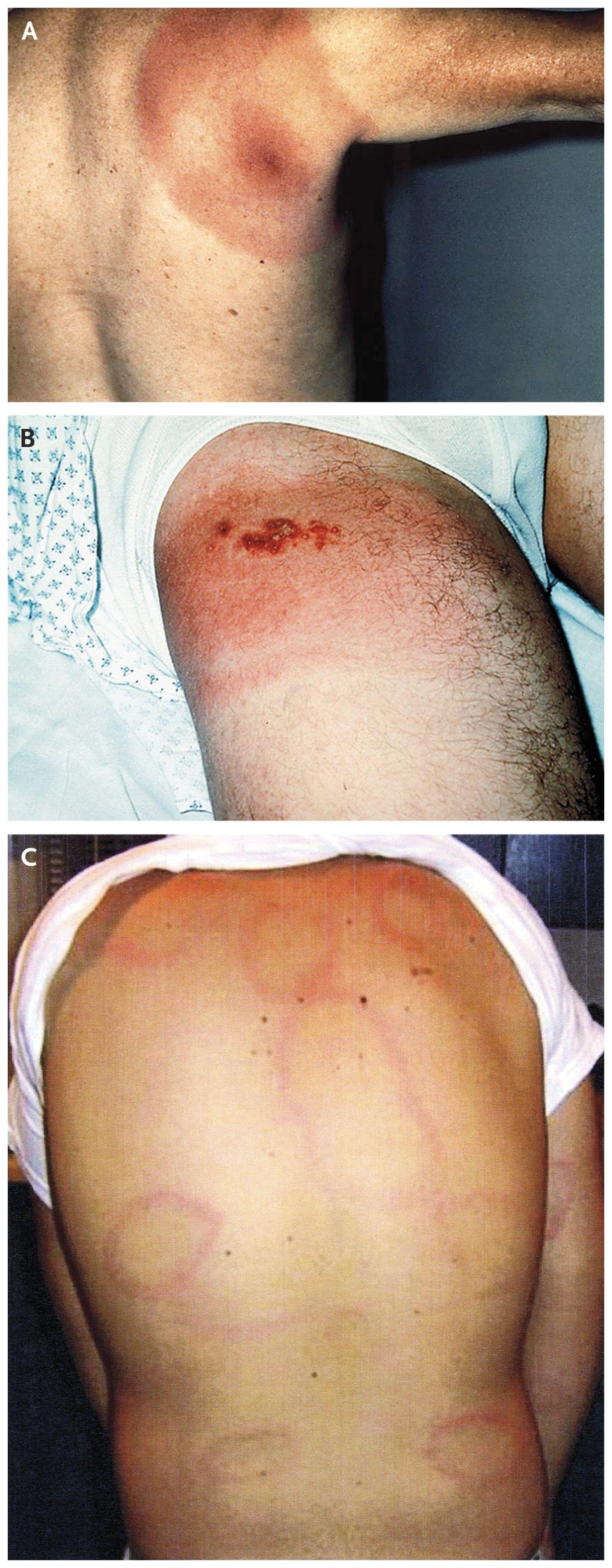 Types of Erythema Migrans.