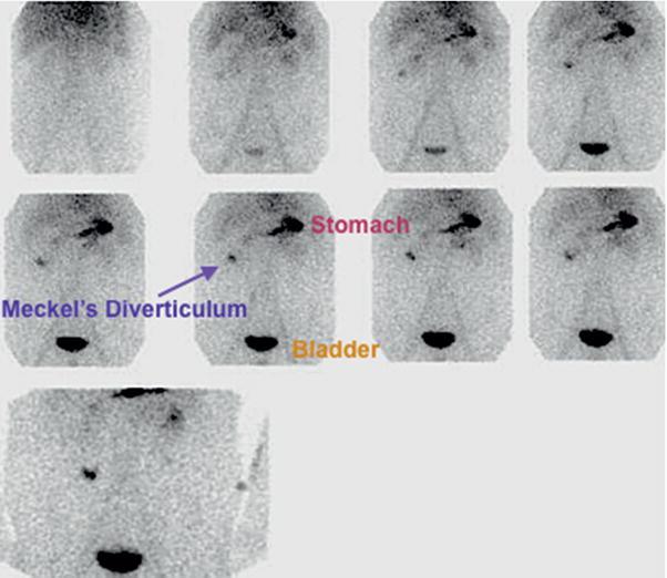 Meckel diverticulum. This 8‐year‐old male with rectal bleeding was pretreated with ranitidine 1 mg/kg IV 20 min before imaging to maximize radiopharmaceutical mucosal uptake. Tc‐99m pertechnetate 0.05 mCi/kg IV was administered. Sequential anterior images show increasing uptake in the stomach over time (LUQ) and simultaneous increasing focal activity in the right midabdomen. The abdominal focal activity is consistent with a Meckel diverticulum. The patient subsequently underwent surgery. Pathology showed a vestigial remnant of omphalomesenteric duct, characteristic of Meckel diverticulum.