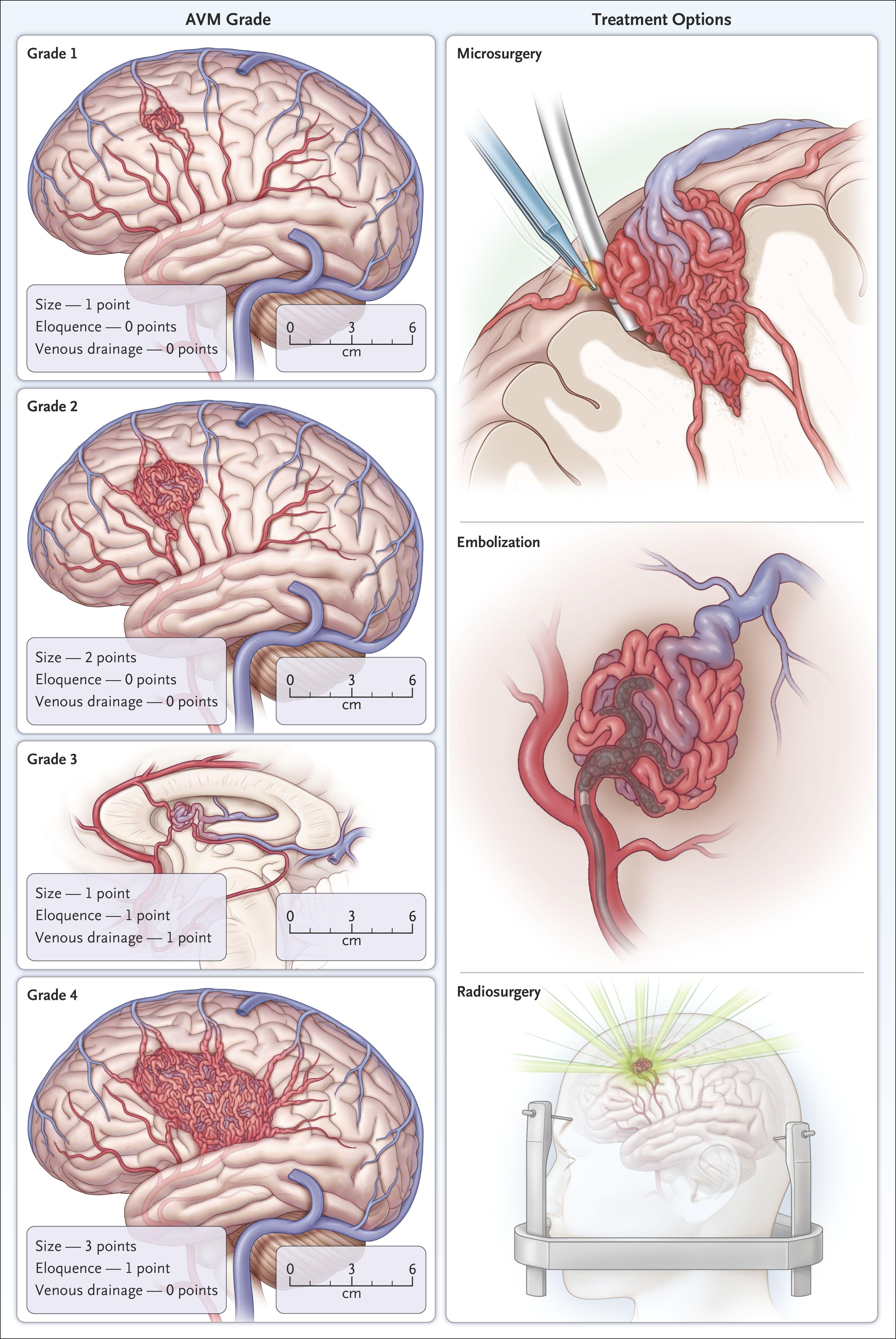 Examples of Spetzler–Martin Grades 1 through 4 Arteriovenous Malformations (AVMs) and Treatment Options.